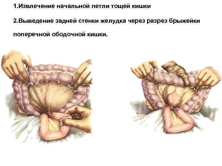 1. Извлечение начальной петли тощей кишки 2. Выведение задней стенки желудка через разрез брыжейки