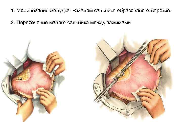 1. Мобилизация желудка. В малом сальнике образовано отверстие. 2. Пересечение малого сальника между зажимами