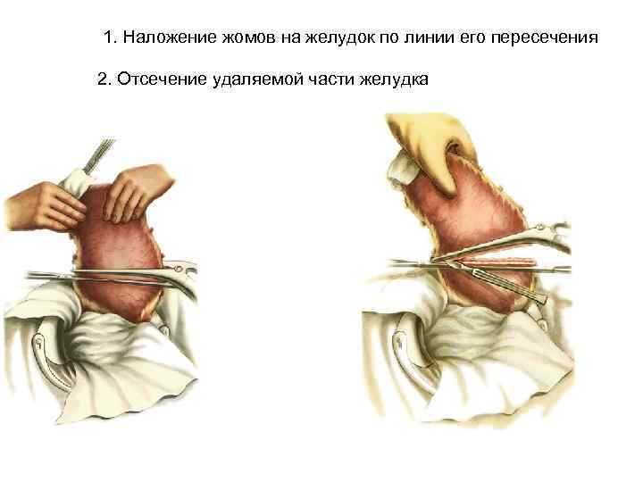 1. Наложение жомов на желудок по линии его пересечения 2. Отсечение удаляемой части желудка