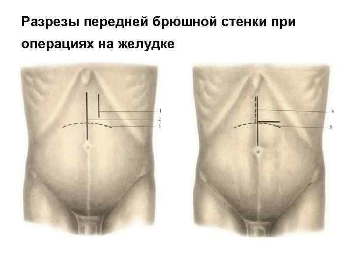 Разрезы передней брюшной стенки при операциях на желудке 
