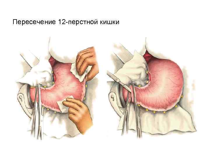 Пересечение 12 -перстной кишки 