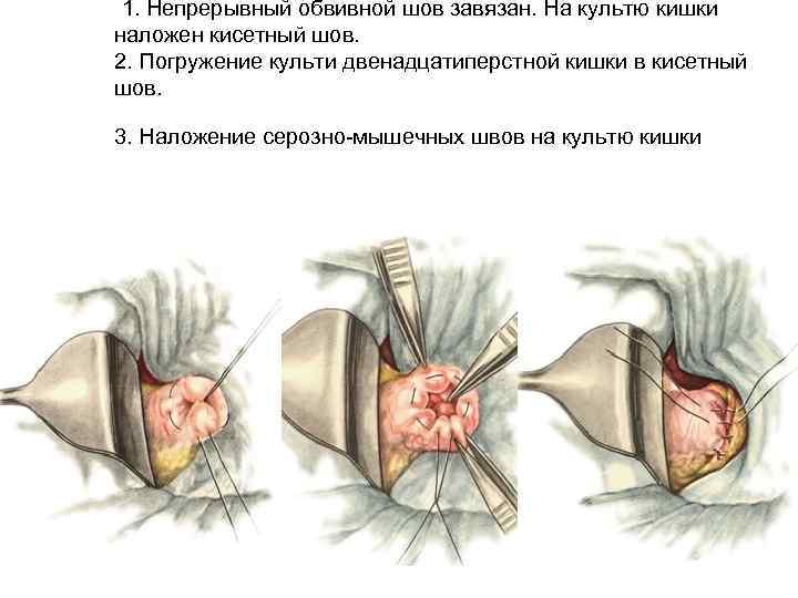 1. Непрерывный обвивной шов завязан. На культю кишки наложен кисетный шов. 2. Погружение культи