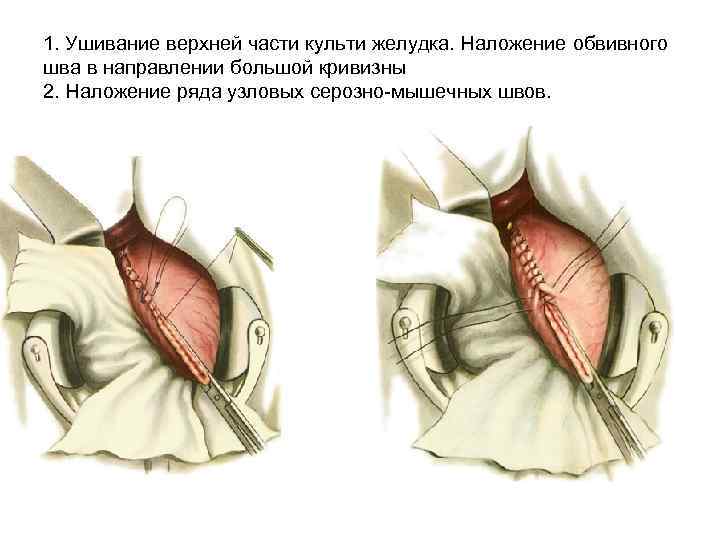 1. Ушивание верхней части культи желудка. Наложение обвивного шва в направлении большой кривизны 2.