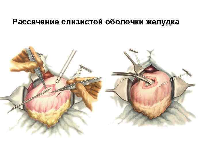 Рассечение слизистой оболочки желудка 