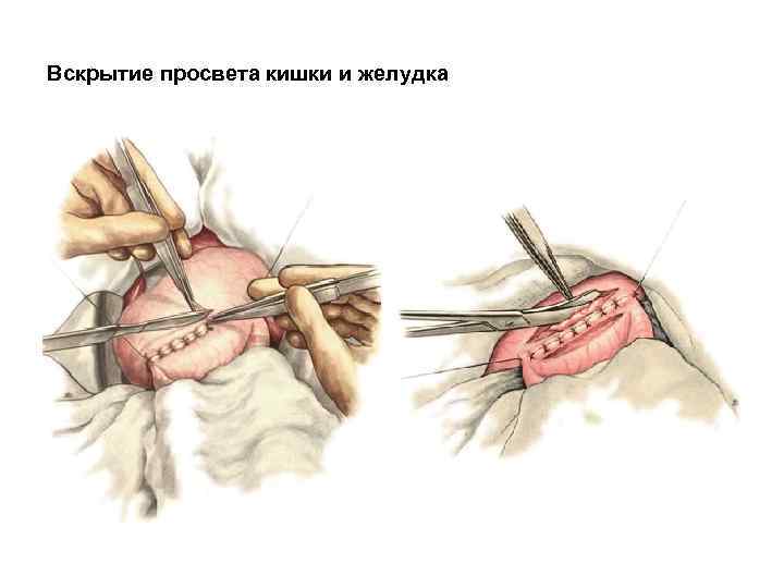 Вскрытие просвета кишки и желудка 