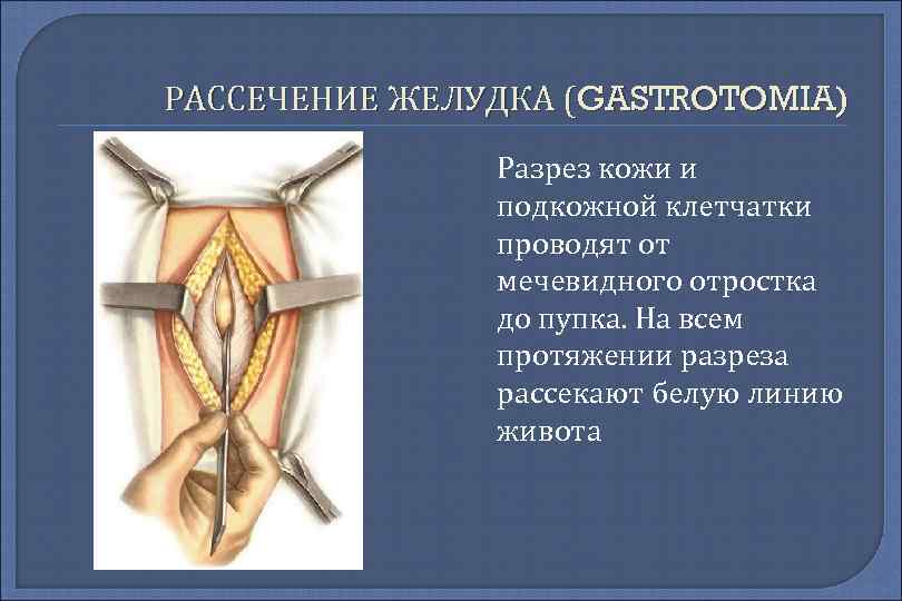 РАССЕЧЕНИЕ ЖЕЛУДКА (GASTROTOMIA) Разрез кожи и подкожной клетчатки проводят от мечевидногo отростка до пупка.