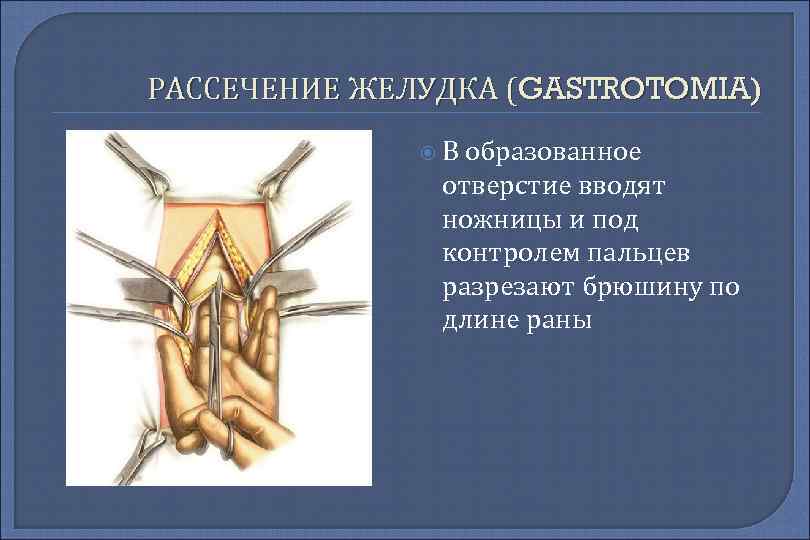 РАССЕЧЕНИЕ ЖЕЛУДКА (GASTROTOMIA) В образованное отверстие вводят ножницы и под контролем пальцев разрезают брюшину