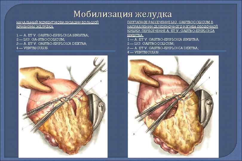 Мобилизация желудка НАЧАЛЬНЫЙ МОМЕНТ МОБИЛИЗАЦИИ БОЛЬШОЙ КРИВИЗНЫ ЖЕЛУДКА. 1 — A. ET V. GASTRO-EPIPLOICA