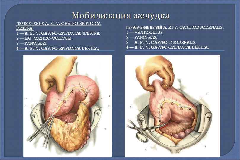 Мобилизация желудка ПЕРЕСЕЧЕНИЕ A. ET V. GASTRO-EPIPLOICA DEXTRA. 1 — A. ET V. GASTRO-EPIPLOICA