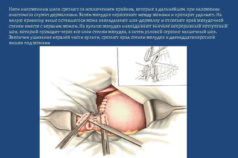 Нити наложенных швов срезают за исключением крайних, которые в дальнейшем при наложении анастомоза служат