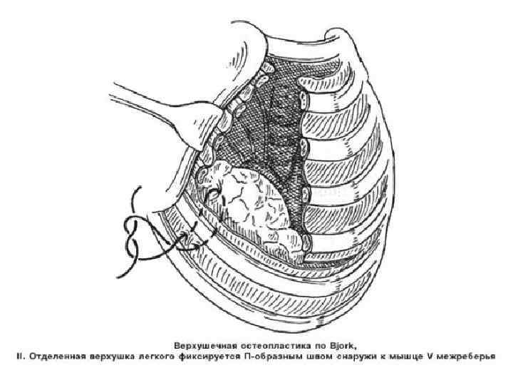 Эмпиема плевры презентация