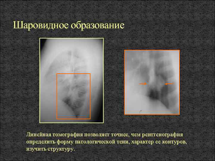 При рентгенографии изображение органов наблюдают на