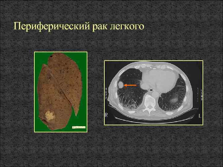 Периферический рак легкого. Феретти рентгенологический атлас заболеваний легких. Поражение периферические отделы лёгких фото.