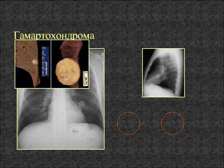 Гамартохондрома 