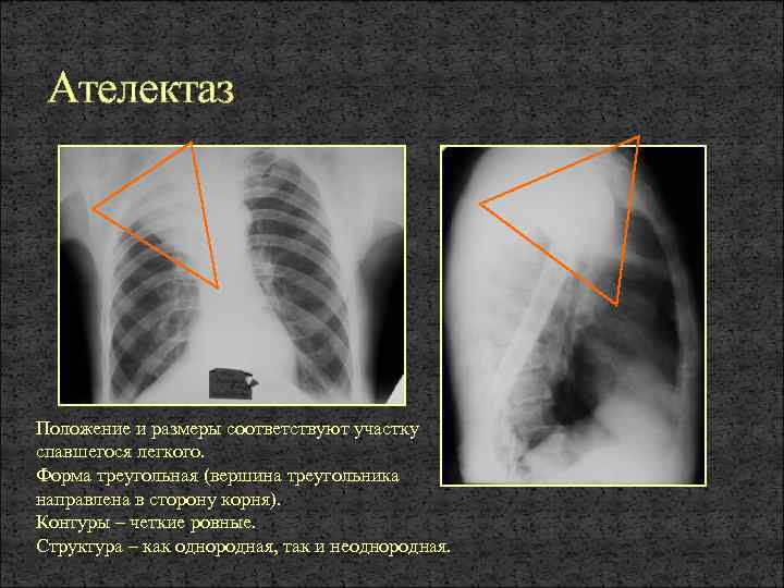 Ателектаз Положение и размеры соответствуют участку спавшегося легкого. Форма треугольная (вершина треугольника направлена в
