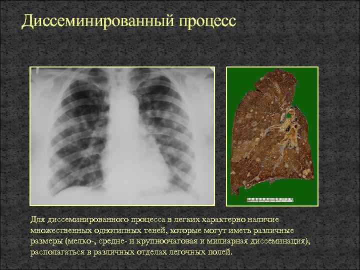 Очаговое поражение легких. Синдром диффузной диссеминации рентген. Диссеминированный туберкулёз лёгких рентген. Диссеминированный процесс в легких рентген. Диссеминированные заболевания легких рентген.