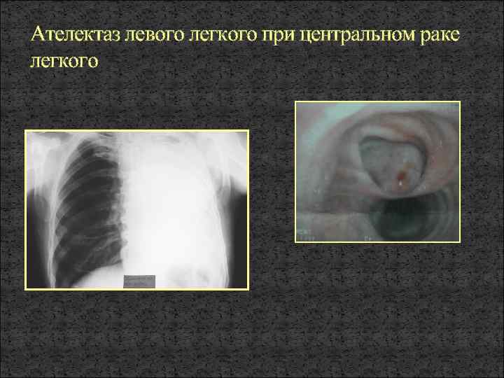 Ателектаз левого легкого при центральном раке легкого 