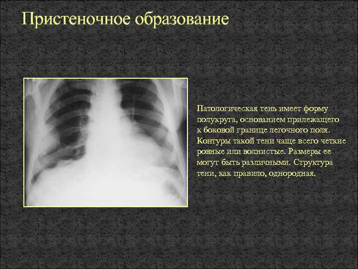 Образование в легких. Патологические тени в легких. Пристеночное образование в легких. Легочные поля границы. Патологическое образование.