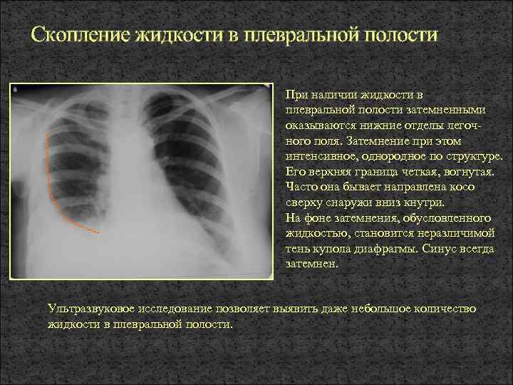 Рентгенологическую картину выпотного плеврита определяют