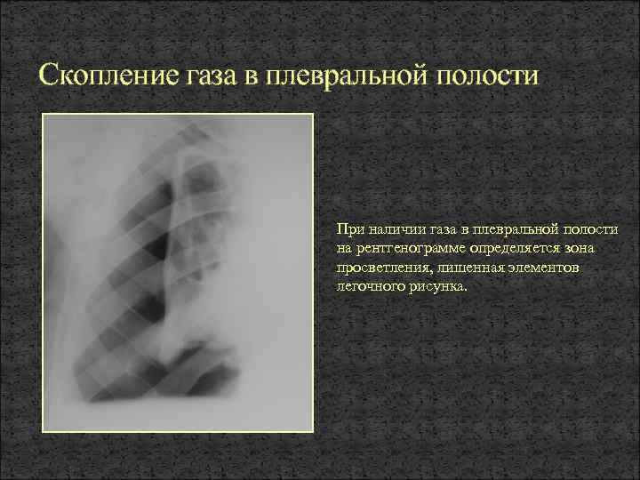 Скопление в плевральной полости. Скопление газа в плевральной полости. ГАЗ В плевральной полости. Свободный ГАЗ В плевральной полости. Патология легочного рисунка на рентгенограмме.