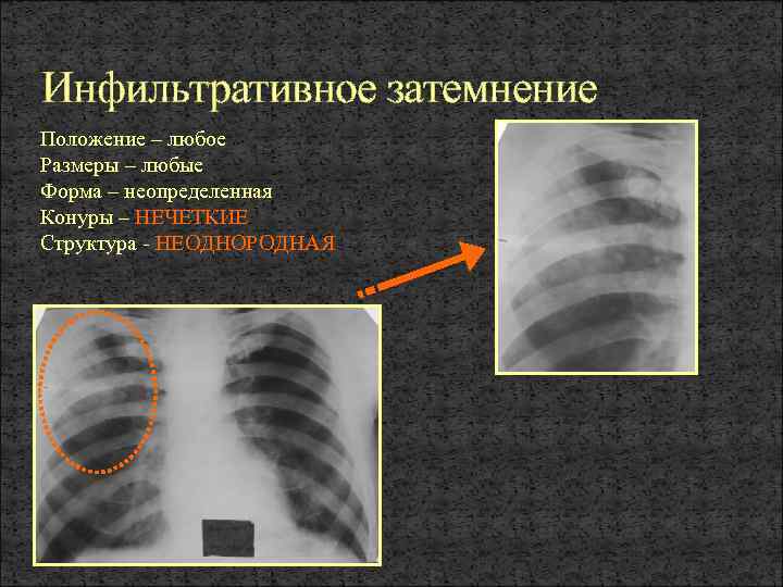 Рентгеновское изображение получают в результате неоднородного