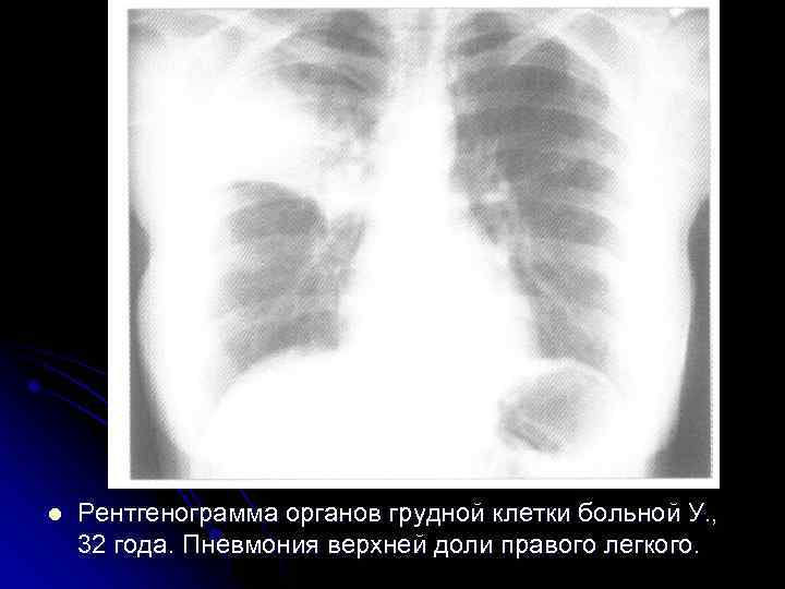Рентгенограмма легких при очаговом туберкулезе легких. Очаги инфильтрации расположены в верхушке правого легкого 