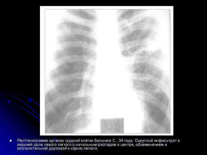 Рентгенограмма легких больного, перенесшего первичный туберкулез легких.  Заметны обызвествленные очаги Гона в верхушке