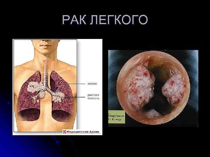 БРОНХОЭКТАЗЫ  l  БЭ при бронхографии 