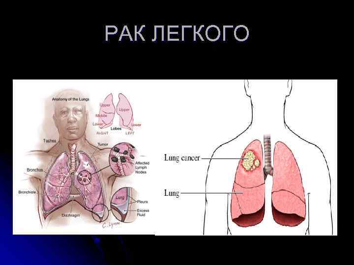 АБСЦЕСС И ГАНГРЕНА ЛЕГКИХ 