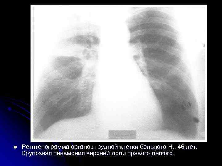 l  Рентгенограмма органов грудной клетки больного С. , 34 года. Округлый инфильтрат в