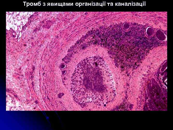 Тромб з явищами організації та каналізації 