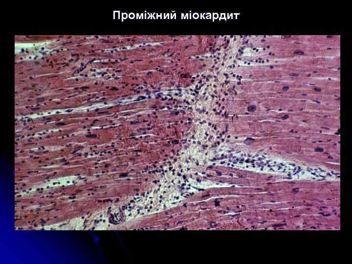 Проміжний міокардит 