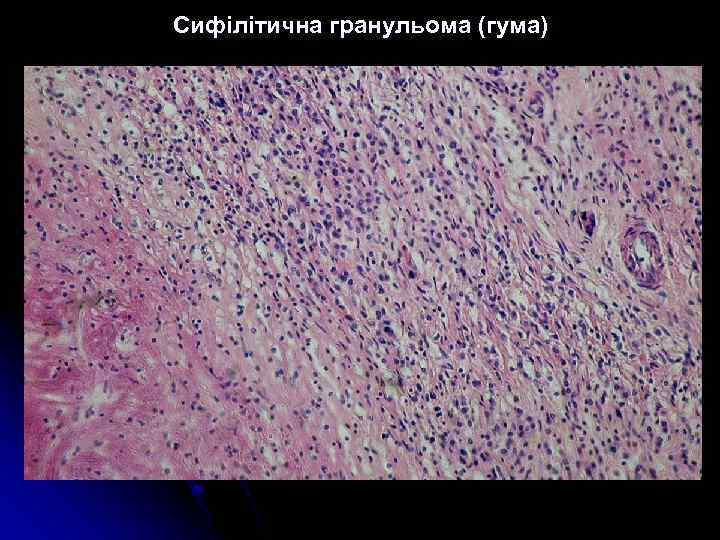 Сифілітична гранульома (гума) 