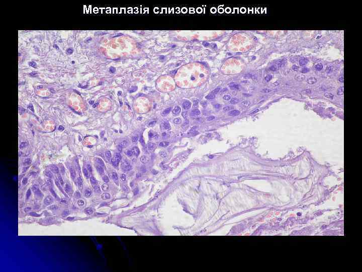 Метаплазія слизової оболонки 