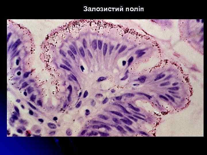 Залозистий поліп 