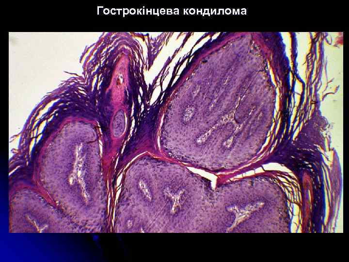 Гострокінцева кондилома 