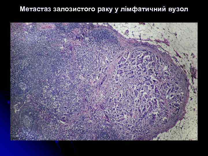 Метастаз залозистого раку у лімфатичний вузол 