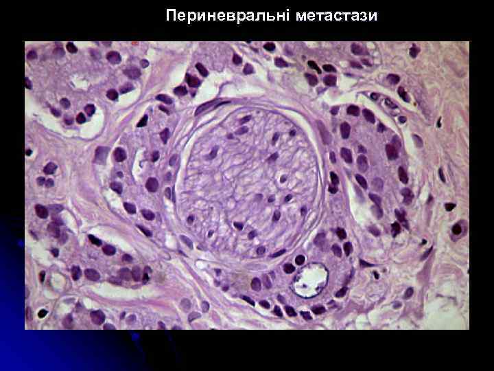 Периневральні метастази 