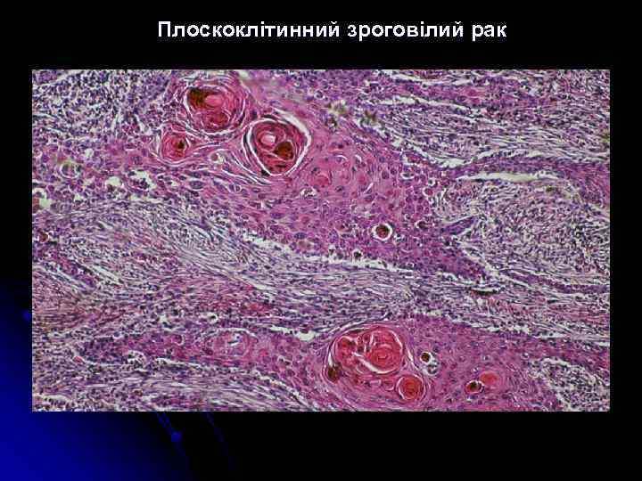 Плоскоклітинний зроговілий рак 