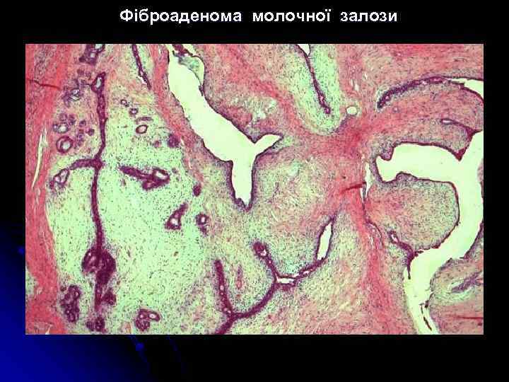 Фіброаденома молочної залози 