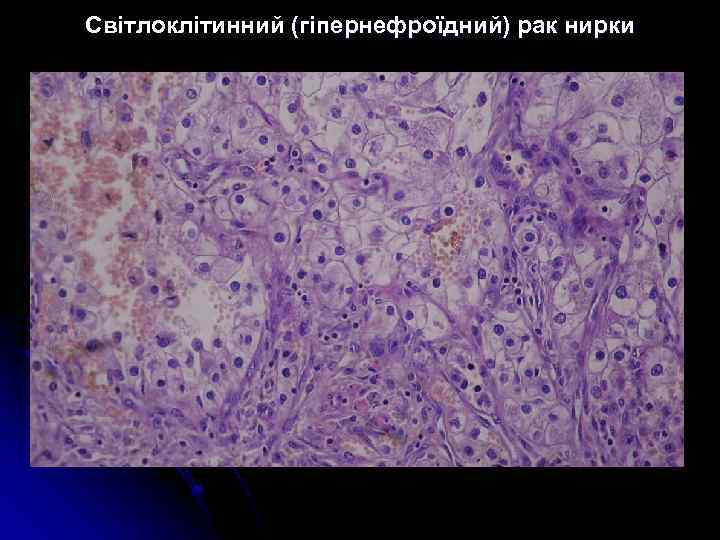 Світлоклітинний (гіпернефроїдний) рак нирки 