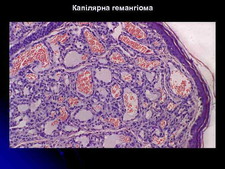 Капілярна гемангіома 