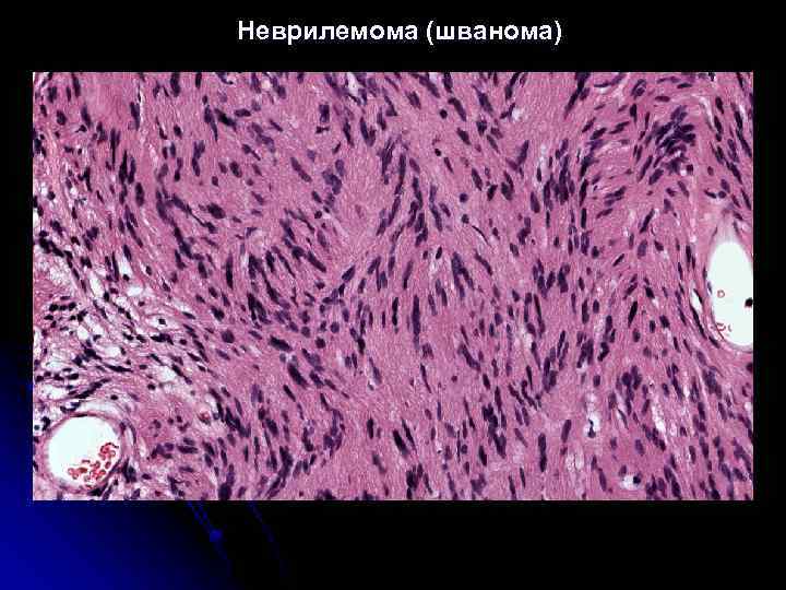 Неврилемома (шванома) 