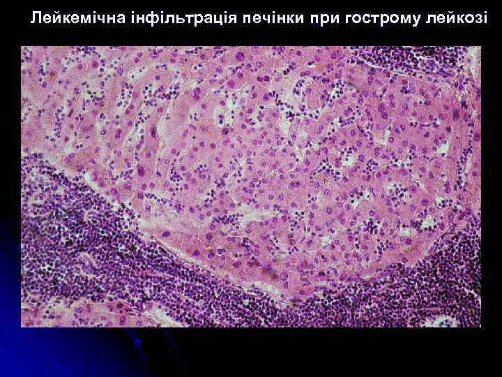 Лейкемічна інфільтрація печінки при гострому лейкозі 