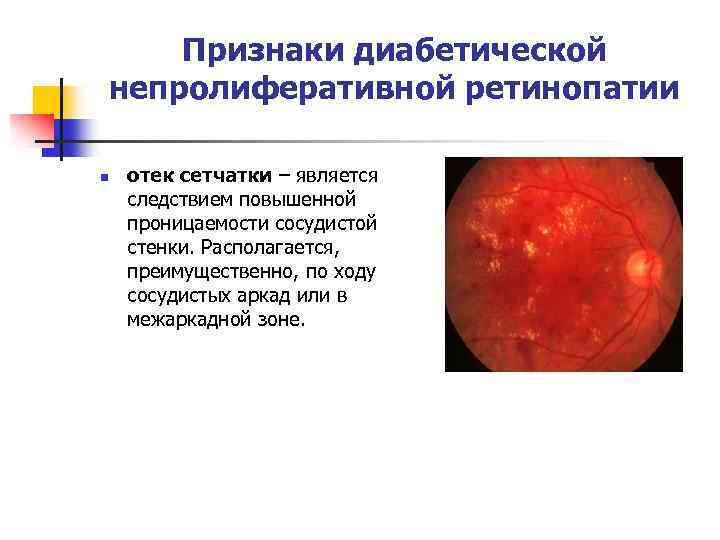 Признаки диабетической непролиферативной ретинопатии n отек сетчатки – является следствием повышенной проницаемости сосудистой стенки.