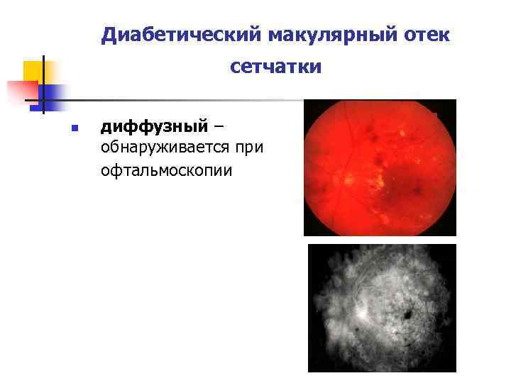 Диабетический макулярный отек сетчатки n диффузный – обнаруживается при офтальмоскопии 