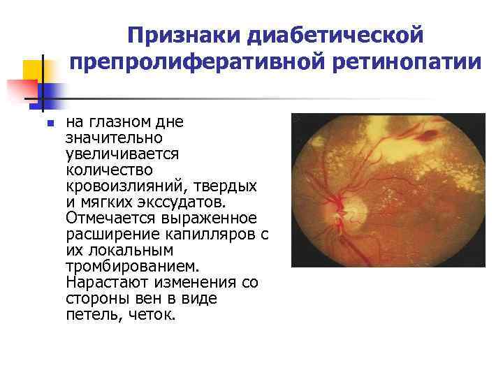 Признаки диабетической препролиферативной ретинопатии n на глазном дне значительно увеличивается количество кровоизлияний, твердых и