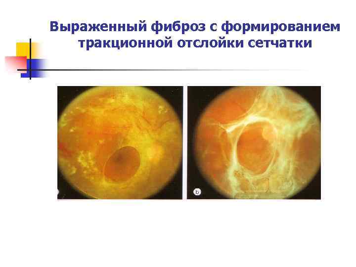 Тракционная отслойка сетчатки фото