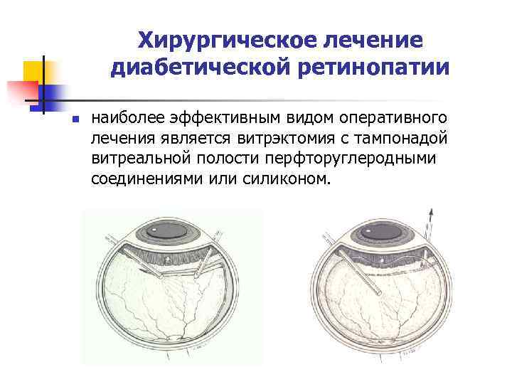 Хирургическое лечение диабетической ретинопатии n наиболее эффективным видом оперативного лечения является витрэктомия с тампонадой