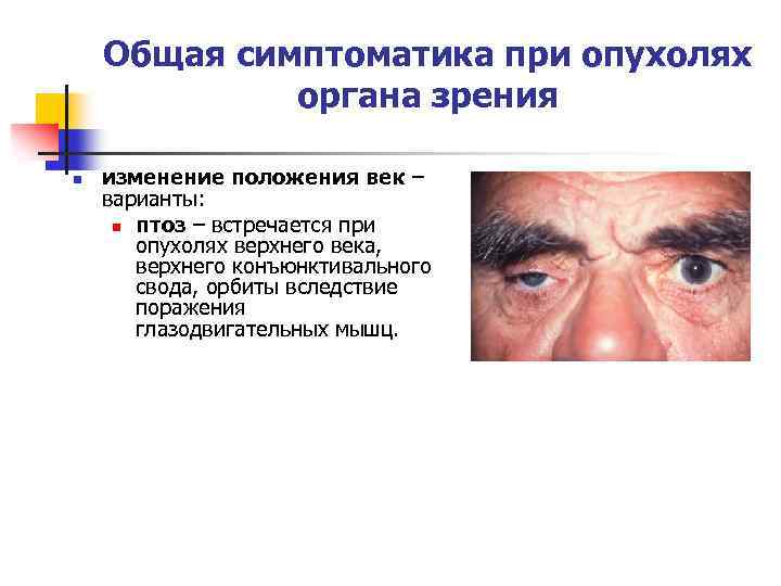 Общая симптоматика при опухолях органа зрения n изменение положения век – варианты: n птоз